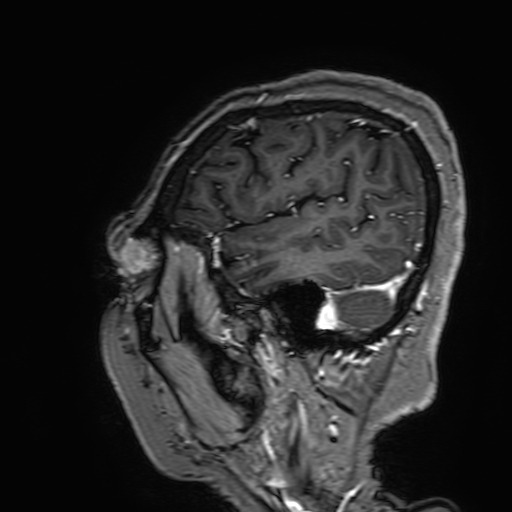 Cavernous hemangioma of the cerebellar falx (Radiopaedia 73025-83724 Sagittal T1 C+ 176).jpg