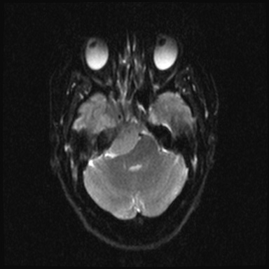 Cavernous sinus meningioma (Radiopaedia 63682-72367 DWI 7).jpg