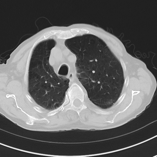 Cavitating pneumonia - lingular segments (Radiopaedia 34386-35678 Axial lung window 17).png
