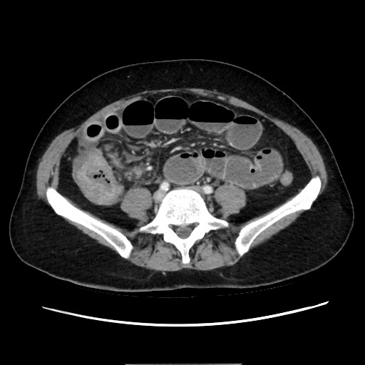 Cecal adenocarcinoma (Radiopaedia 75909-87331 A 58).jpg
