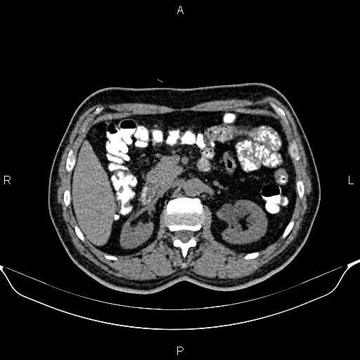 Cecal adenocarcinoma (Radiopaedia 85324-100916 Axial non-contrast 35).jpg