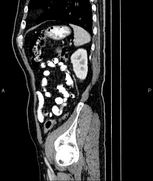 Cecal cancer with appendiceal mucocele (Radiopaedia 91080-108651 E 78).jpg
