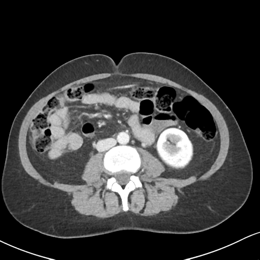 Cecal internal hernia through the foramen of Winslow (Radiopaedia 44820-48651 B 40).png