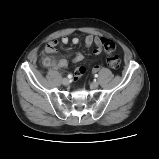 File:Cecal mass causing appendicitis (Radiopaedia 59207-66531 A 67).jpg