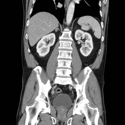 Cecal mass causing appendicitis (Radiopaedia 59207-66531 B 34).jpg