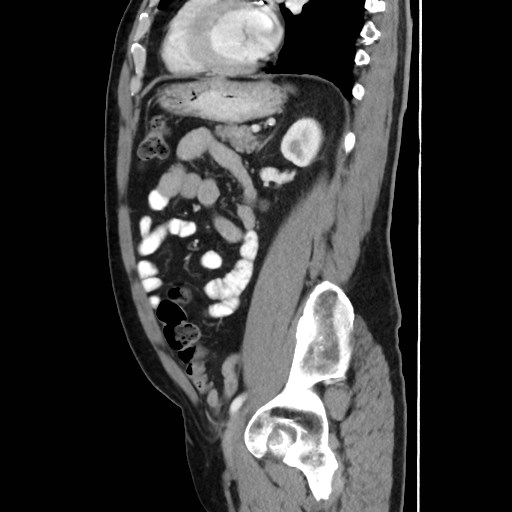 Cecal mass causing appendicitis (Radiopaedia 59207-66531 C 43).jpg
