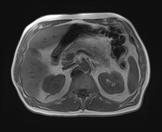 File:Cecal mass causing appendicitis (Radiopaedia 59207-66532 Axial T1 in-phase 48).jpg