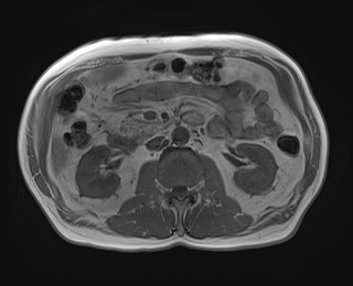 Cecal mass causing appendicitis (Radiopaedia 59207-66532 Axial T1 in-phase 62).jpg