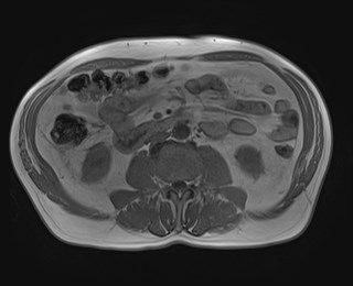 Cecal mass causing appendicitis (Radiopaedia 59207-66532 Axial T1 in-phase 73).jpg