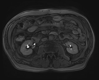 Cecal mass causing appendicitis (Radiopaedia 59207-66532 K 65).jpg