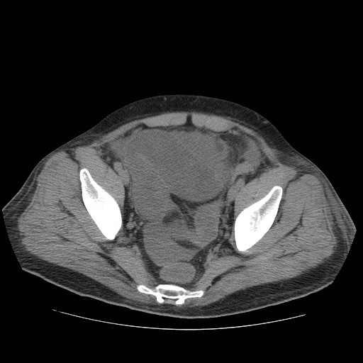 Cecal volvulus (Radiopaedia 28294-28534 Axial non-contrast 79).jpg
