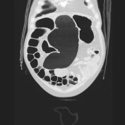 Cecal volvulus (Radiopaedia 75378-86620 Coronal lung window 36).jpg