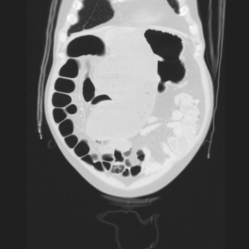 Cecal volvulus (Radiopaedia 75378-86620 Coronal lung window 39).jpg