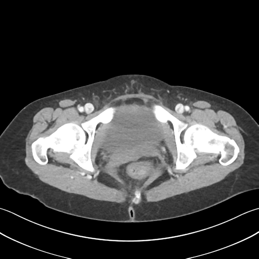 Cecum hernia through the foramen of Winslow (Radiopaedia 46634-51112 A 72).png