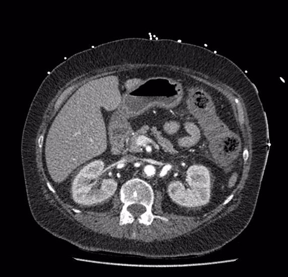 Celiac artery severe stenosis and dissection (Radiopaedia 44128-47842 B 32).jpg