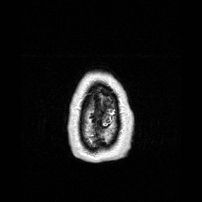 Central-variant posterior reversible encephalopathy syndrome (PRES) (Radiopaedia 43880-47358 Axial T1 C+ 169).jpg