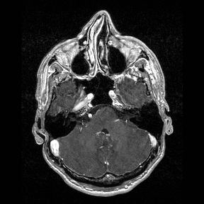 File:Central-variant posterior reversible encephalopathy syndrome (PRES) (Radiopaedia 43880-47358 Axial T1 C+ 32).jpg