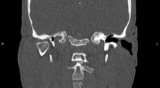 File:Central giant cell granuloma (Radiopaedia 83346-97761 Coronal bone window 31).jpg