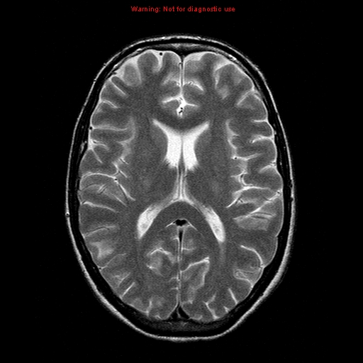 File:Central nervous system vasculitis (Radiopaedia 8410-9235 Axial T2 14).jpg