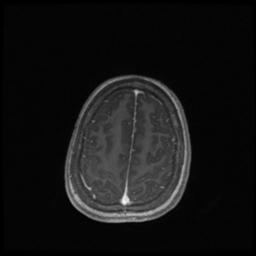 Central neurocytoma (Radiopaedia 30220-30842 Axial T1 C+ 126).jpg