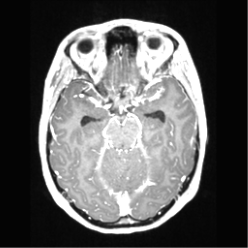 Central neurocytoma (Radiopaedia 37664-39557 Axial T1 C+ 31).png
