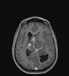 Central neurocytoma (Radiopaedia 84497-99872 Axial T1 C+ 95).jpg