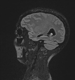 File:Central neurocytoma (Radiopaedia 84497-99872 Sagittal Flair + Gd 47).jpg