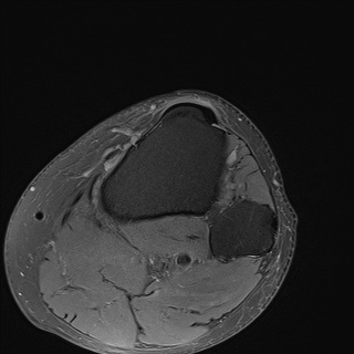 File:Central osteophyte (Radiopaedia 72592-83151 Axial PD fat sat 33).jpg