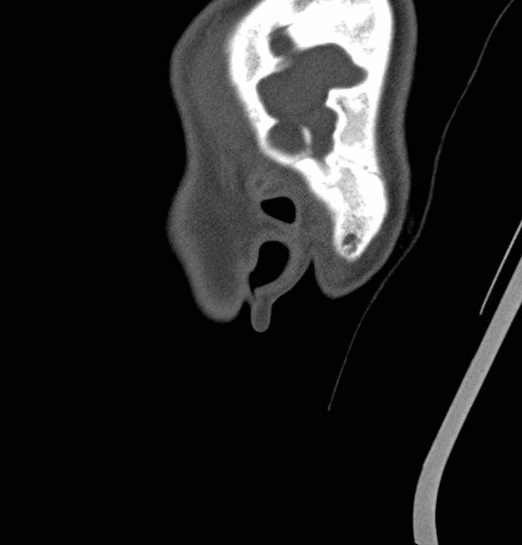 Cerebellar abscess (Radiopaedia 73727-84527 Sagittal bone window 47).jpg