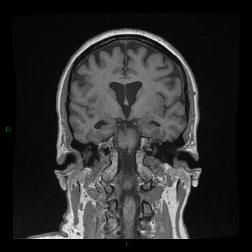 Cerebellar abscess (Radiopaedia 78135-90678 Coronal T1 C+ 78).jpg