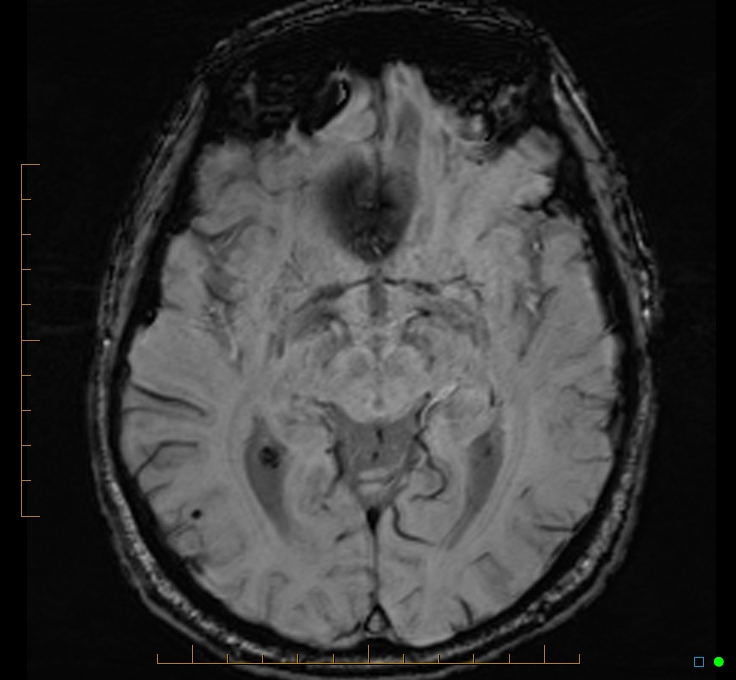 Cerebellar gangliocytoma (Radiopaedia 65377-74422 Axial SWI 26).jpg