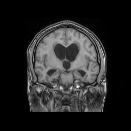 File:Cerebellar hemangioblastoma (Radiopaedia 88055-104622 Coronal T1 18).jpg