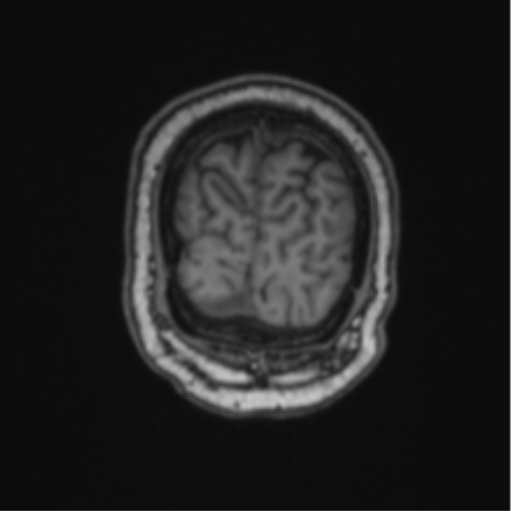 File:Cerebellar hemangioblastomas and pituitary adenoma (Radiopaedia 85490-101176 Coronal T1 15).png