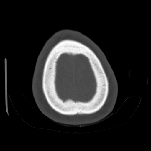 Cerebellar metastasis (cystic appearance) (Radiopaedia 41395-44258 Axial bone window 66).png