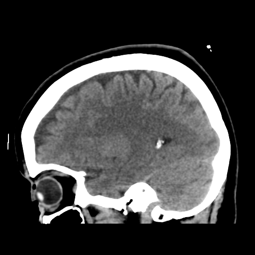 Cerebellar metastasis (cystic appearance) (Radiopaedia 41395-44258 E 20).png