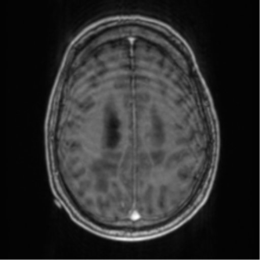 Cerebellar metastasis from lung adenocarcinoma (Radiopaedia 86690-102829 Axial T1 C+ 58).png