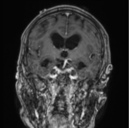 Cerebellar metastasis from lung adenocarcinoma (Radiopaedia 86690-102829 Coronal T1 C+ 56).png