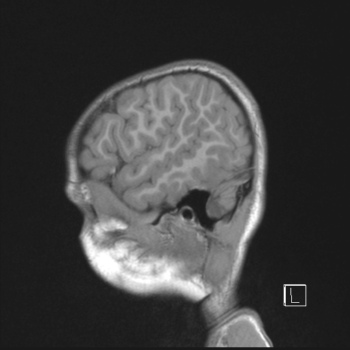 Cerebellar stroke (Radiopaedia 32202-33150 Sagittal T1 C+ 7).png