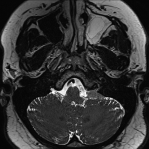 Cerebellopontine angle meningioma (Radiopaedia 48434-53348 Axial T2 Space 36).png