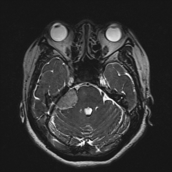 Cerebellopontine angle meningioma (Radiopaedia 53561-59591 Axial 3D volume T2 71).jpg