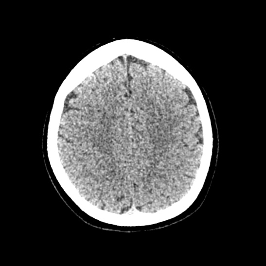 Cerebellopontine angle meningioma (Radiopaedia 53561-59592 Axial non-contrast 50).jpg
