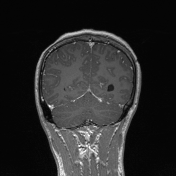 Cerebral abscess (Radiopaedia 24212-24478 Coronal T1 C+ 158).jpg