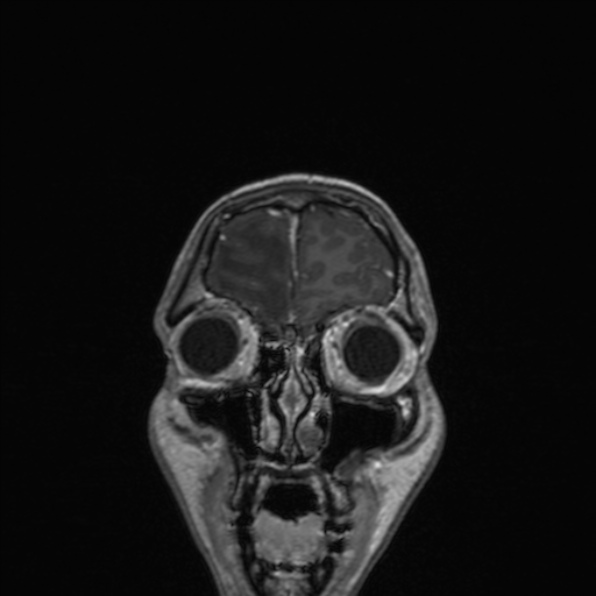 Cerebral abscess (Radiopaedia 24212-24478 Coronal T1 C+ 41).jpg