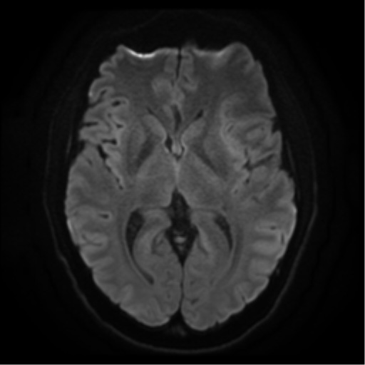 Cerebral abscess (Radiopaedia 57774-64740 Axial DWI 14).png