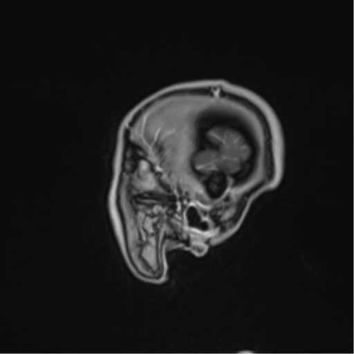 Cerebral abscess (Radiopaedia 60342-68009 J 51).png