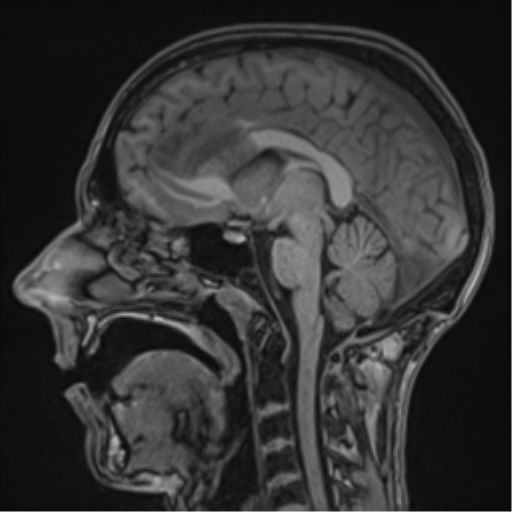 Cerebral abscess (Radiopaedia 60342-68009 Sagittal T1 29).png