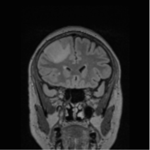 Cerebral abscess from pulmonary arteriovenous malformation (Radiopaedia 86275-102291 Coronal FLAIR 63).png