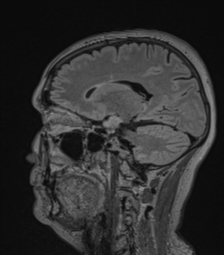 Cerebral abscess from pulmonary arteriovenous malformation (Radiopaedia 86275-102291 Sagittal FLAIR 30).png