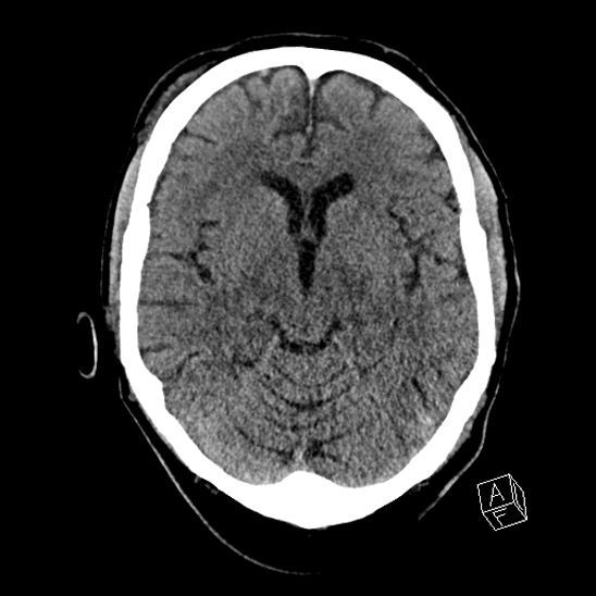 File:Cerebral abscess with ventriculitis (Radiopaedia 78965-91876 Axial non-contrast 23).jpg