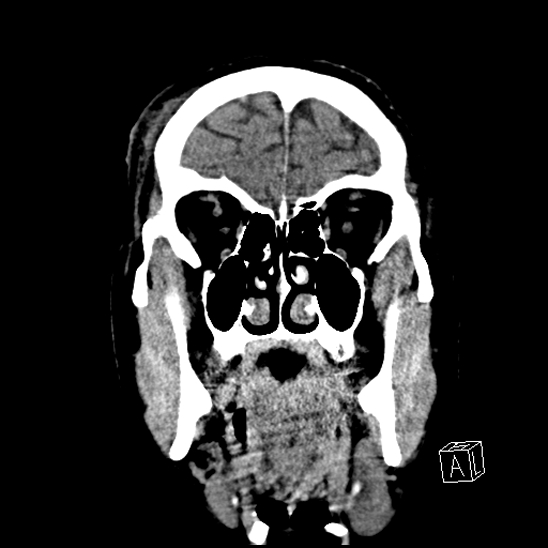File:Cerebral abscess with ventriculitis (Radiopaedia 78965-91876 B 11).jpg
